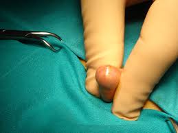 Circumcision Clinic